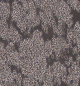 NB4人急性早幼粒細(xì)胞白血病細(xì)胞主圖